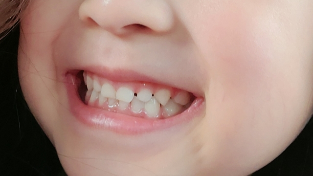 お子さまの歯並びが気になっていませんか